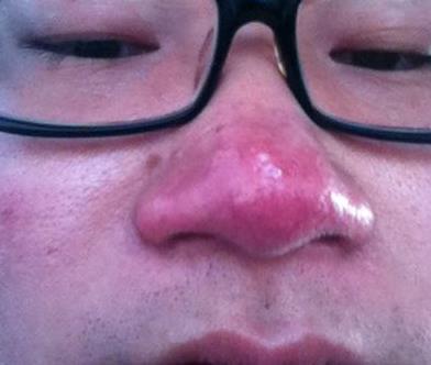 过敏性鼻炎|小小虫子不可轻视,过敏疾病的祸首就是它
