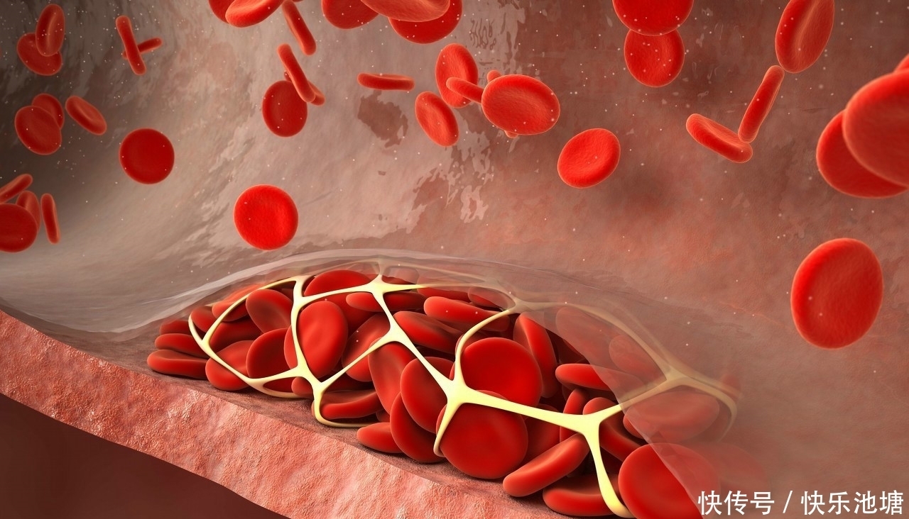 血栓发出的第一个信号,常常是疼痛,45岁以后你该去检查血管