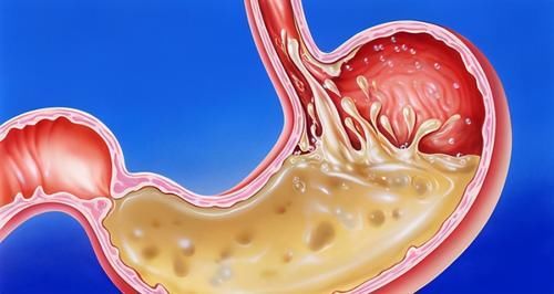食管炎|胃食管反流应该如何治疗？什么原因导致的，如何保养