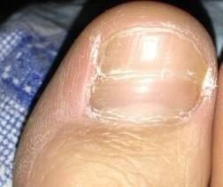 匙状甲|宝宝指甲中,隐藏着哪些关于健康的小秘密