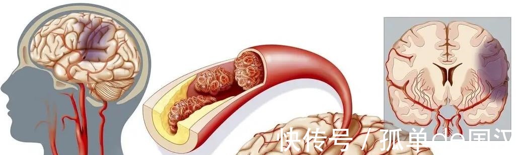 高血糖|高血脂或是“吃”出来的预防高血脂，这“3物”尽量要少吃