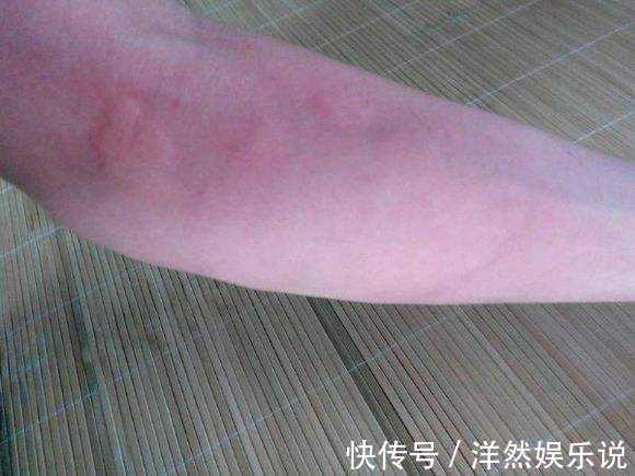 次数|减少荨麻疹发作次数，我送你一张“对穴方”！中医思维的体现