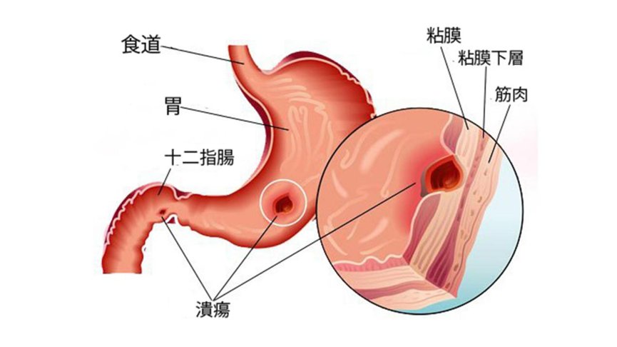 饮食习惯|糜烂性胃炎严重吗？医生：如不注意会引发胃溃疡，造成更严重后果