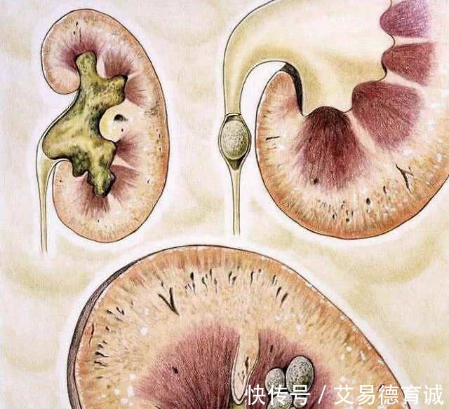 胱氨酸结石|预防肾结石一定要管住嘴，从结石成分来看饮食也是很重要的