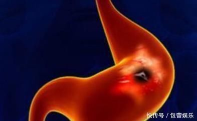 吞咽困难|当你的身体发出以下4个“信号”时,有可能胃癌找上门来了!