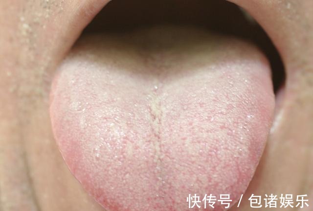 癌症|身体里有肿瘤，舌头上也会有表现！出现3种异象需小心