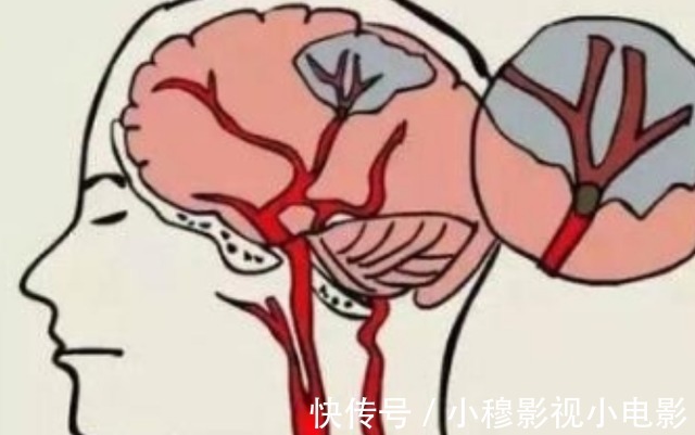 高血压|高血压达到多少,会引起脑溢血?提醒:最好别超过这个范围