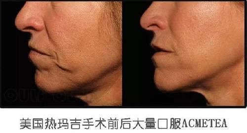 什么是热玛吉你真想不到、【热玛三太】吃多久提升效果？