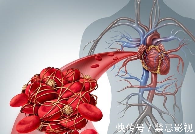 急性脑血栓|清除血栓的“冠军”食物是什么?