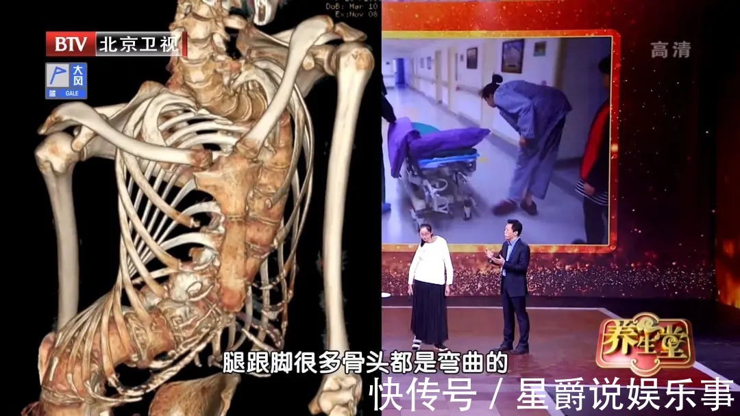 王主任|60岁后,你的骨骼可能正在“散架”!一吃一动,补营养,强骨骼