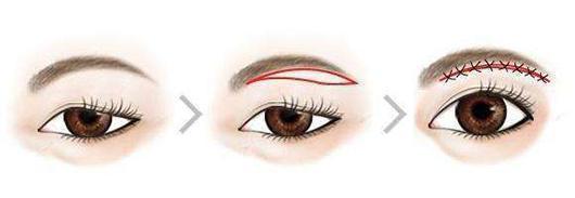 王小民教授 王小民教授:眼周衰老,提眉与切眉哪个更适合你呢?