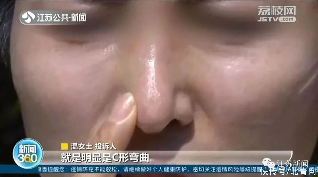 女子鼻头右偏去整形，没想到修成了整个鼻子朝左歪