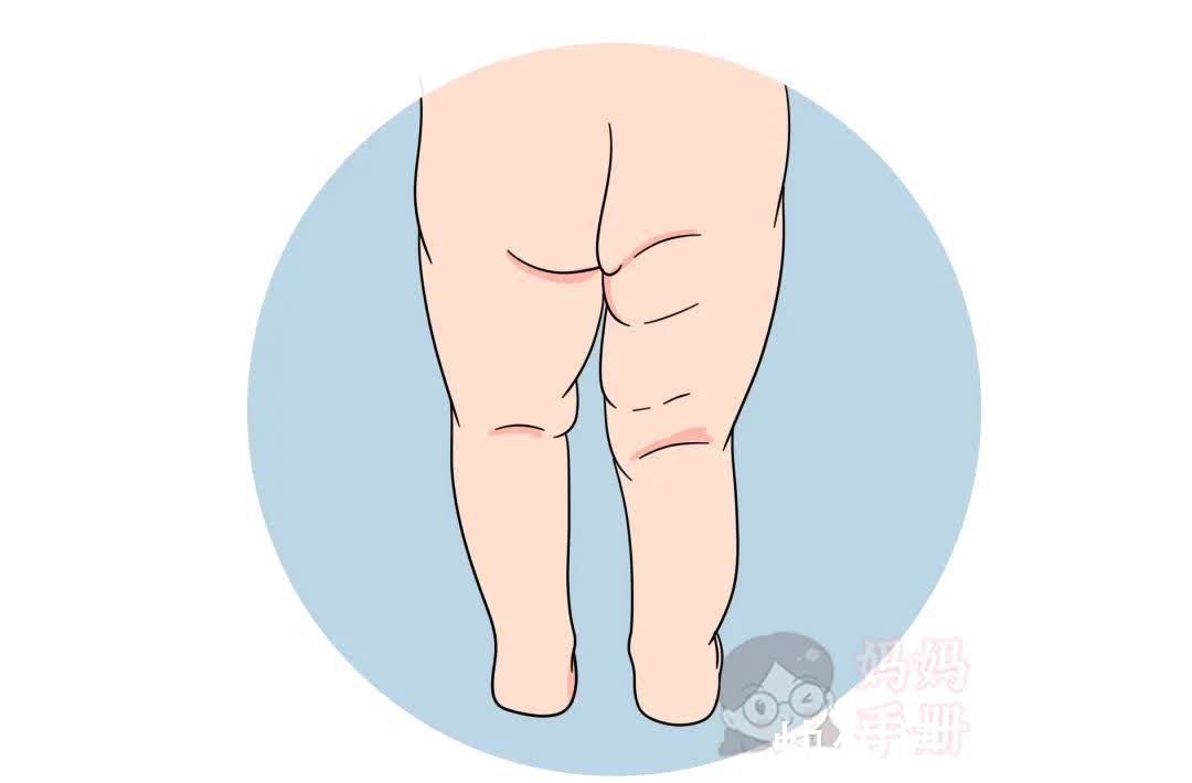 髋关节|孩子这样走路,暗示发育出现大问题!越早发现越好!