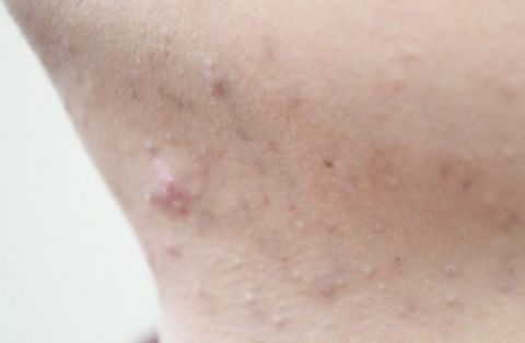 增生|结节、息肉、囊肿、增生...哪个才是癌症的先兆