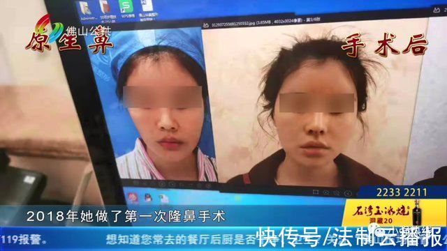 鼻子 隆鼻后不满意，女子再做鼻子修复手术!这次仍不满意?