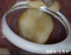 牙齿|一口下去7000元没了！方脸、国字脸特别注意，中秋前后多发