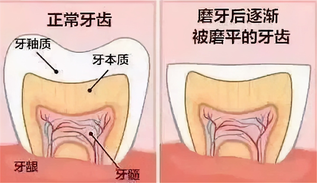 牙齿|夜间睡觉还会磨牙、流口水？赶紧看看你的牙齿有没有问题