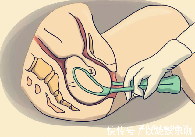 姿势|“大夫,我能换个姿势吗?”宝妈这句话,为宝宝免去“产钳”之苦