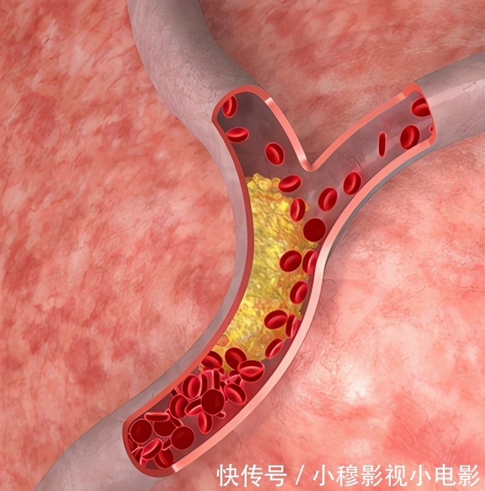 美国心脏协会|脑梗死越来越多,哈佛大学医学院:坚持做到这7件事,远离脑梗