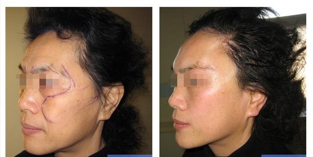 拉皮手术 拉皮术后即刻,47岁的我找回了消失已久的“少女感”!