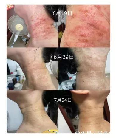 炎琥宁|无意义的输液正在成为危及生命的杀手——死亡突如其来