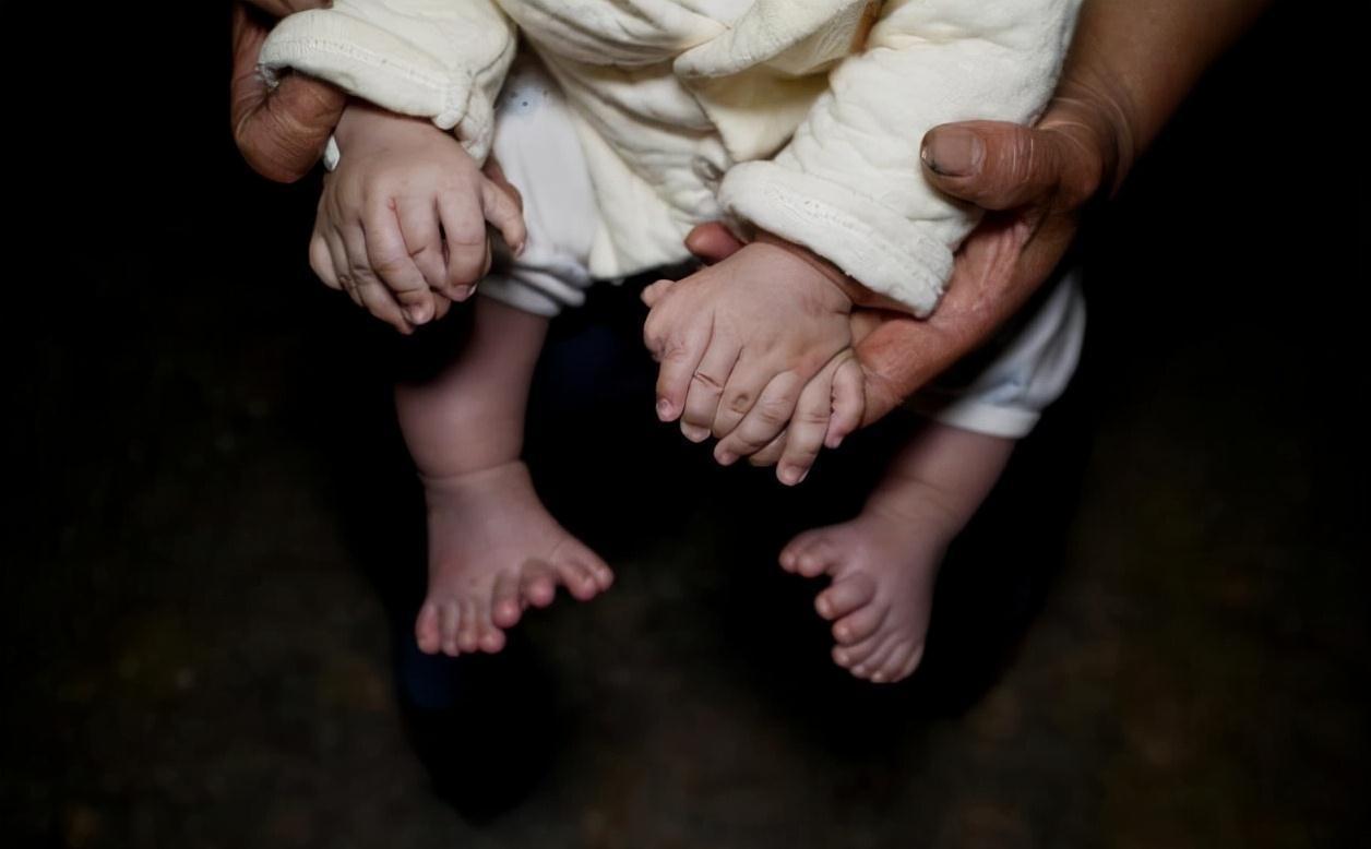 多指症|3个月大的男婴为何长出31根指头?得知原因后母亲崩溃痛哭