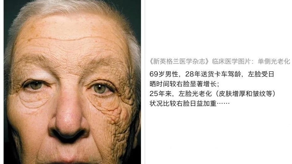 别再傻傻的晒太阳,晒太阳带给你的不只是黑,还有这些