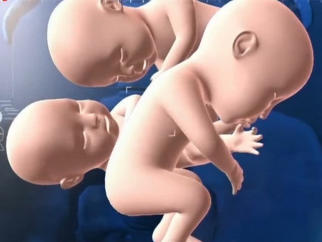 孕妇怀四胞胎以为是儿子,结果生四个女儿,爸爸产房外手舞足蹈