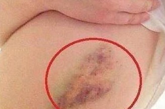 指甲|注意癌症早期,身体会出现3个症状,早看早预防