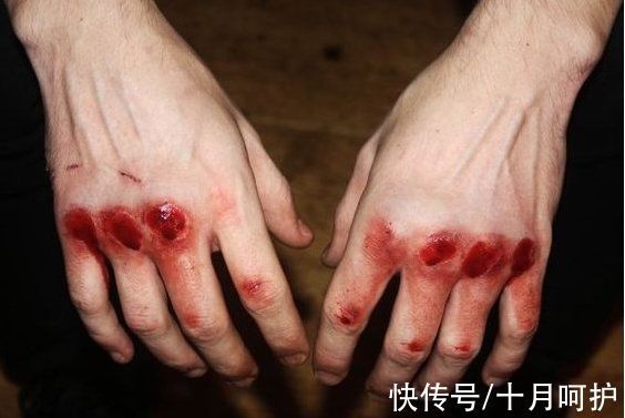 残疾|三岁女童被活活截断手指,终生残疾!只因用错创可贴,快自查