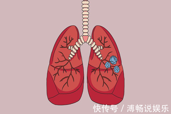 结节|7毫米的肺结节，6个月就变成癌，医生2种肺结节，尽早处理