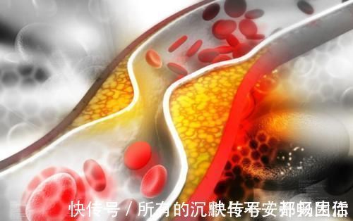 血管堵塞|脑梗的“罪魁祸首”被揪出,医生这2类食物再馋也要管住嘴