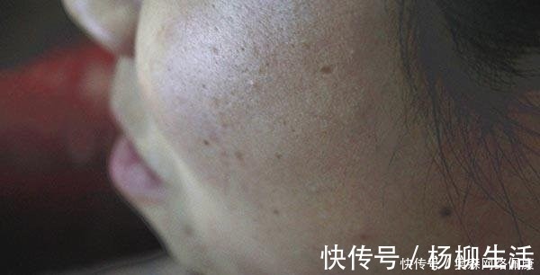 蜘蛛痣|肝病先上脸，脸部出现什么变化，暗示肝脏病得不轻了？别大意