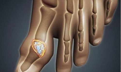 串串|3种食物是尿酸的“催化剂”,不想痛风缠身,尽量要少吃