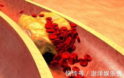 动脉粥样硬化|老护士长儿子31岁高血压5年,突发脑梗偏瘫失语!留下只有遗憾