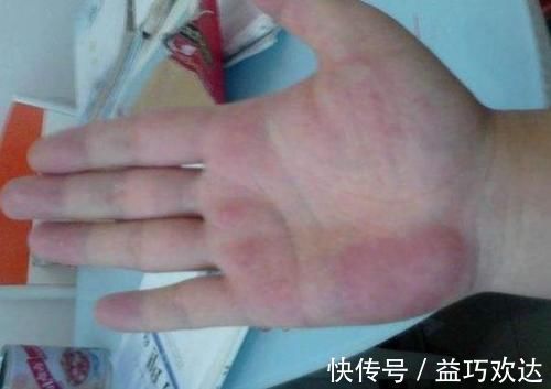 头晕头痛|血管堵,手先知,手上若有这4种表现,可能是血管堵了