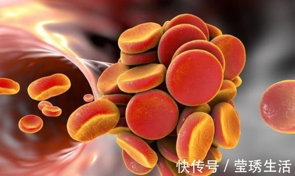 胆固醇|天然“溶栓之王”终被发现,促进血液循环,悄悄减少血栓形成!