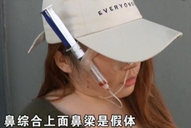女子整容花费6万元,脸上天天挂着注射器,医院赔你13000