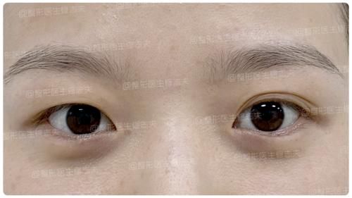 逼疯强迫症的一单一双眼皮，手术能不能只做单侧？