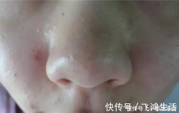 水乳|先别慌着挤黑头,这3种原因你知道了再挤也不迟