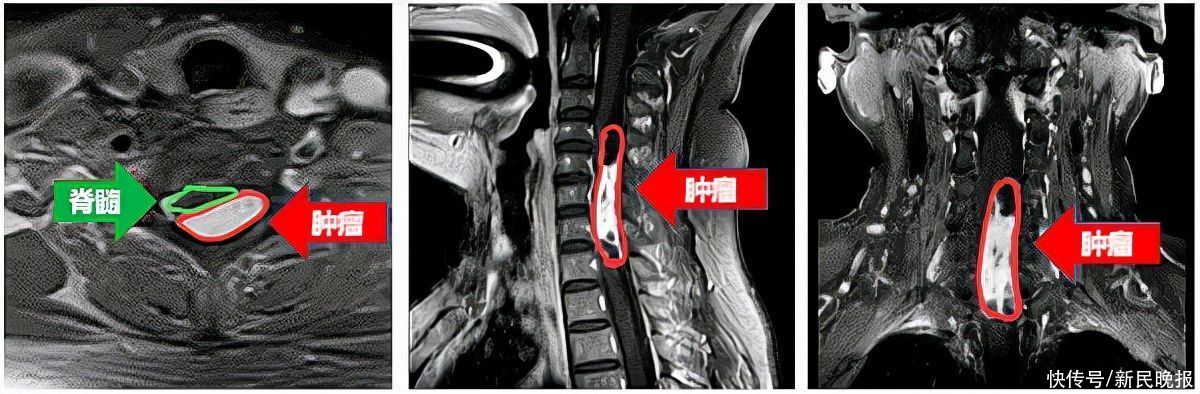 骨伤科|患者椎管内潜藏巨大肿瘤 龙华医院骨伤科团队精心治疗除隐患