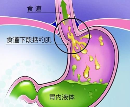 药物|治疗胃食管反流，这四种药一定要了解