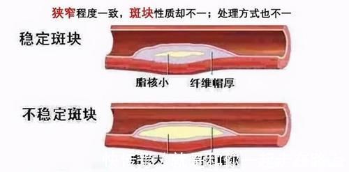 颈动脉|颈动脉有斑块，会有哪些症状？应该如何治疗？医生告诉你答案