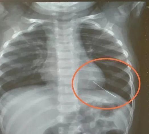 家属|3岁女孩天天咳嗽,医院检查后,医生怒斥家属:“太粗心了”