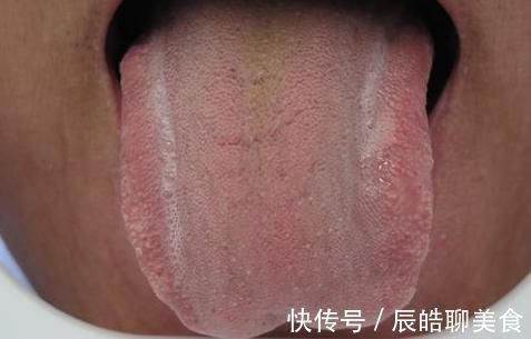 糖尿病|80后精神小伙患2型糖尿病,医生感叹太年轻,5种舌象很常见要当心