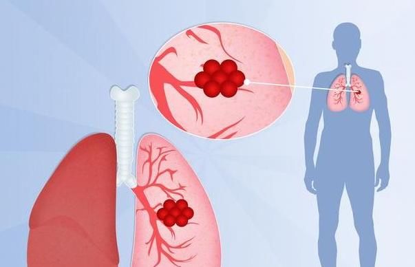  红灯|肺癌发现就是晚期？其实4个“红灯”会提醒你，不要在忽视了！