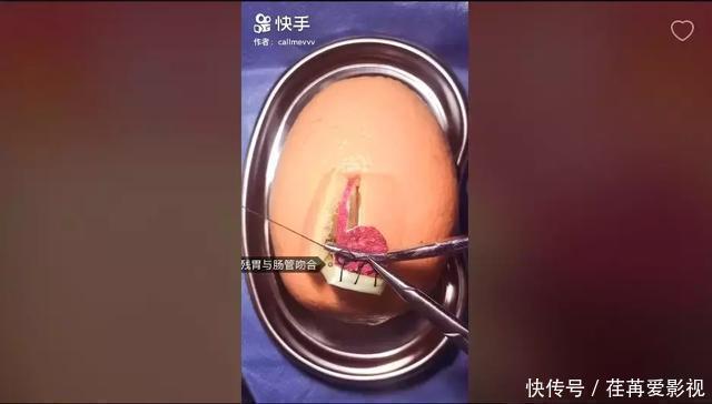 王醫生|32歲醫生竟給水果做手術？一夜吸粉12萬！網友：“我的膝蓋跪爛了”