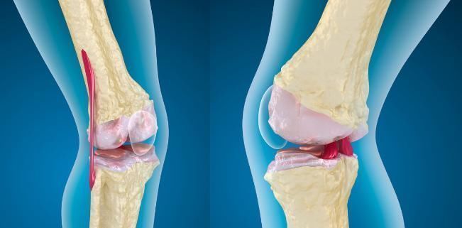 腰痛|骨碎补,名字即功效,用于肾阳亏虚所致腰痛,耳鸣耳聋,牙痛久泻