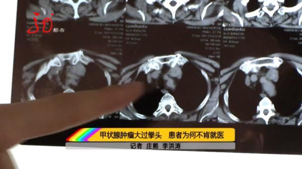 胸腔|真危险!肿瘤从老人脖子长到胸腔!四分之三以上气管被堵死!