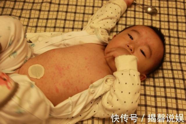 皮疹|宝宝出现9个特点,可能是患急疹了,教你5个方法,在家就能护理